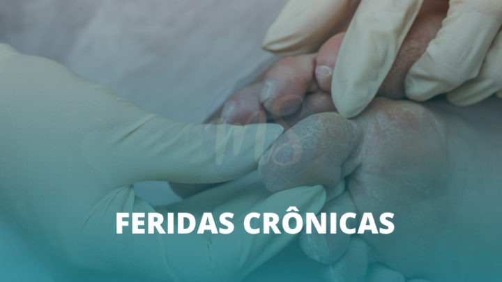 Estomaterapeuta trata ferida crônica e promove autocuidado eficaz