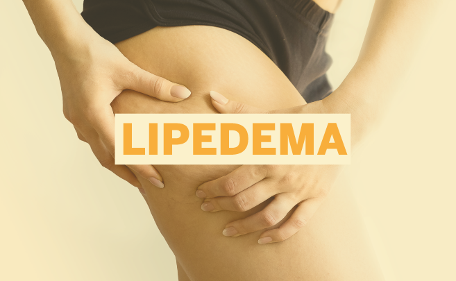 Lipedema: mais de 10 milhões de brasileiras podem ter a doença e não sabem