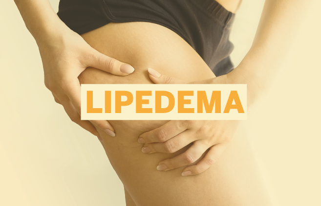 Lipedema: mais de 10 milhões de brasileiras podem ter a doença e não sabem