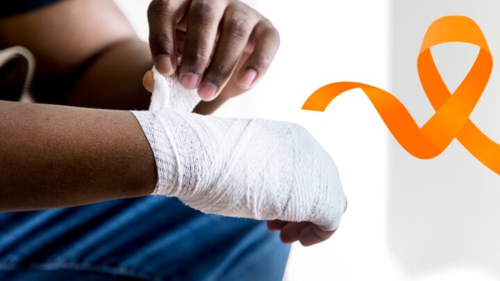Junho Laranja: cirurgião alerta sobre os riscos de queimaduras e como tratá-las