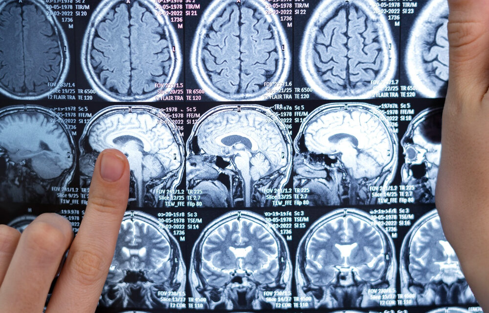 Neurocirurgião esclarece dúvidas sobre tumor cerebral 