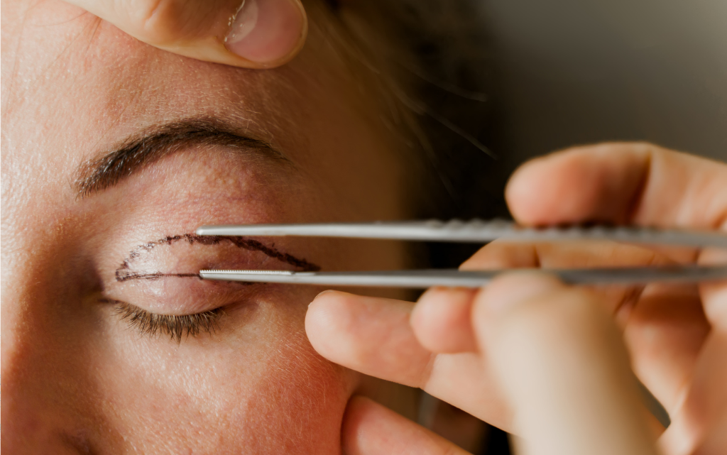 Blefaroplastia: procedimento que rejuvenesce o olhar