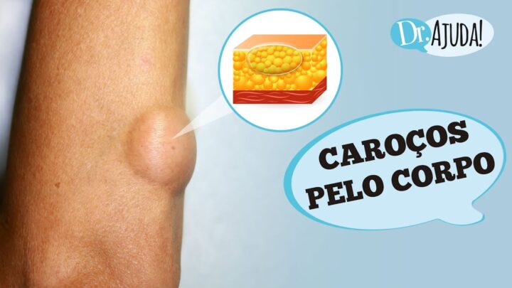 Caroços pelo corpo e lipoma: O que são? O que reparar?