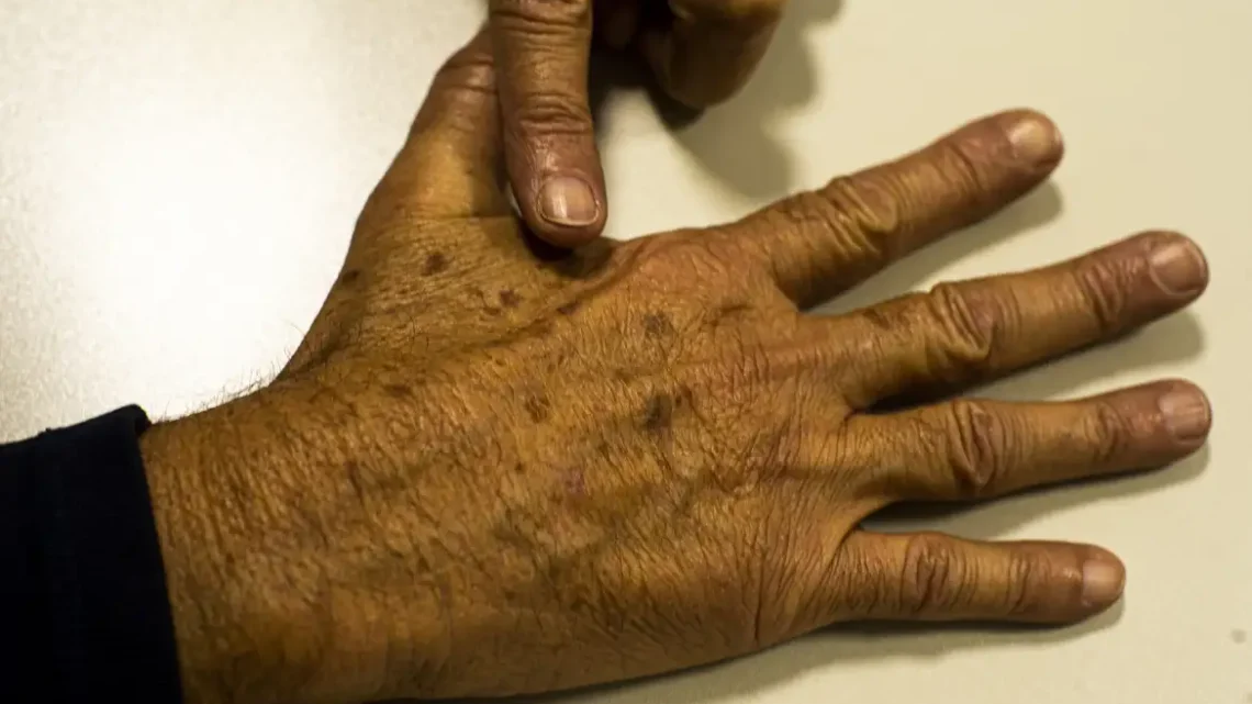 Câncer de pele: com a chegada do verão, prevenção é fundamental para evitar a doença