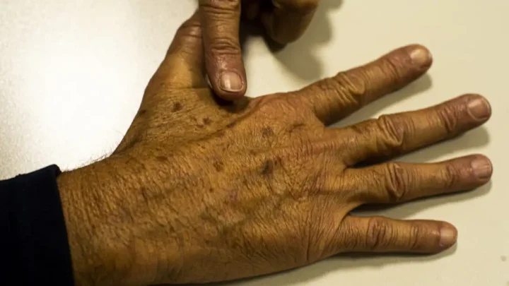 Câncer de pele: com a chegada do verão, prevenção é fundamental para evitar a doença