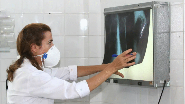 Tuberculose: Amazonas lidera incidência no Brasil, seguido por Roraima e Rio de Janeiro