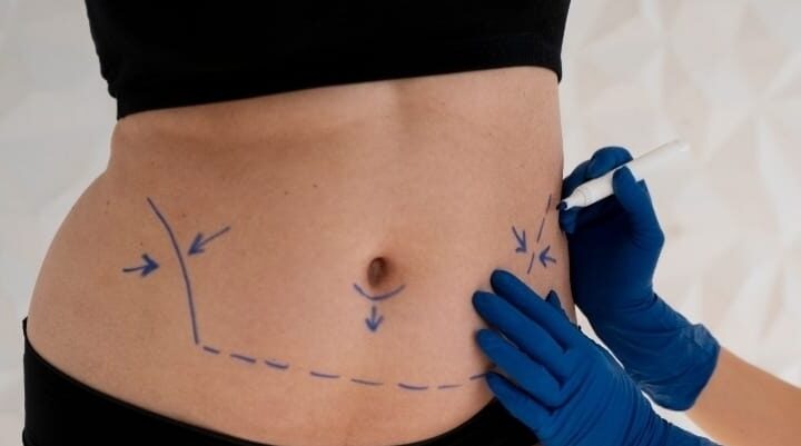 Mini ou abdominoplastia: especialista aponta melhor escolha