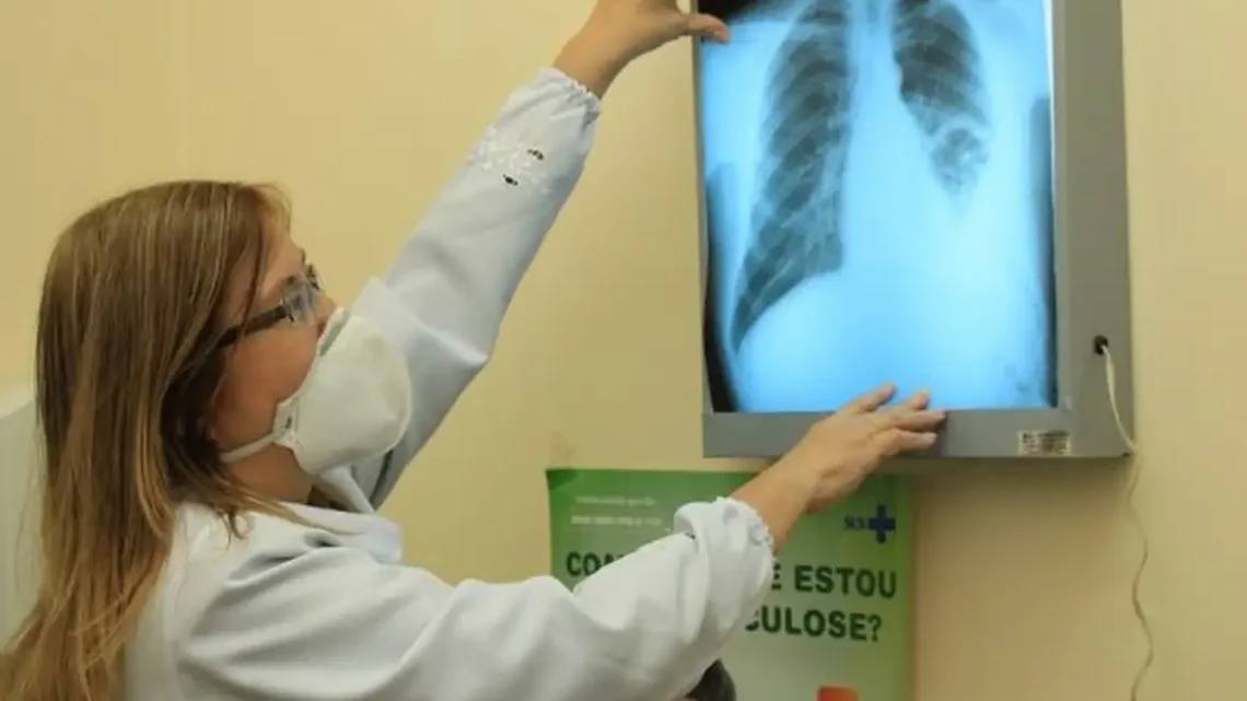 Ministério da Saúde repassa R$ 100 milhões para combate à tuberculose em 913 municípios