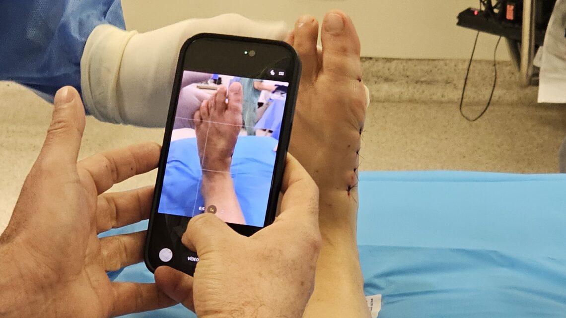 Tratamento das joanetes avança com cirurgia pouco invasiva