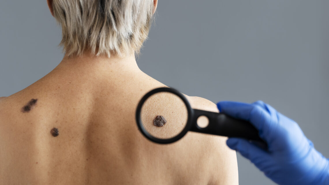 Verão Laranja: quando o culto ao bronze e a desinformação digital alimentam o câncer de pele no Brasil