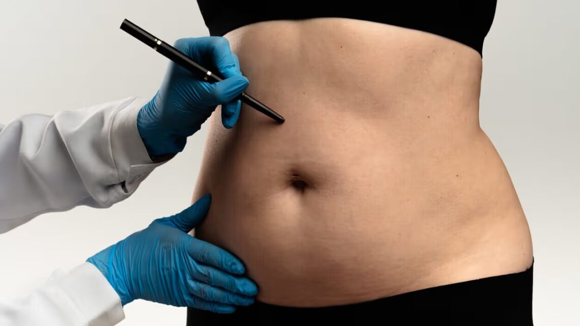 Lipoaspiração lidera preferência por cirurgias plásticas
