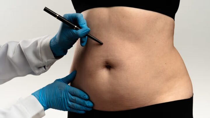 Lipoaspiração lidera preferência por cirurgias plásticas